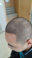 点击看大图 -大麦微针植发丨全国连锁