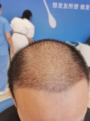 -大麦微针植发全国连锁