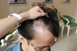 -大麦微针植发丨全国连锁