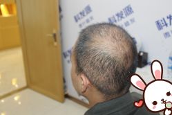 -大麦微针植发丨全国连锁