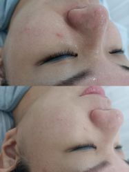 体验后-SKIN79皮肤管理中心