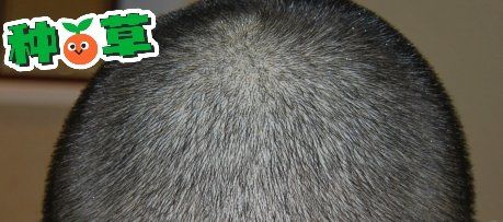 -大麦微针植发丨全国连锁