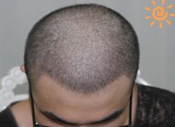 -大麦微针植发丨全国连锁