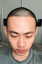 -碧莲盛·不剃发植发