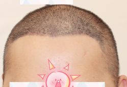 -大麦微针植发全国连锁