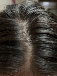 -碧莲盛·不剃发植发