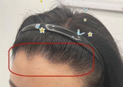 -大麦微针植发全国连锁