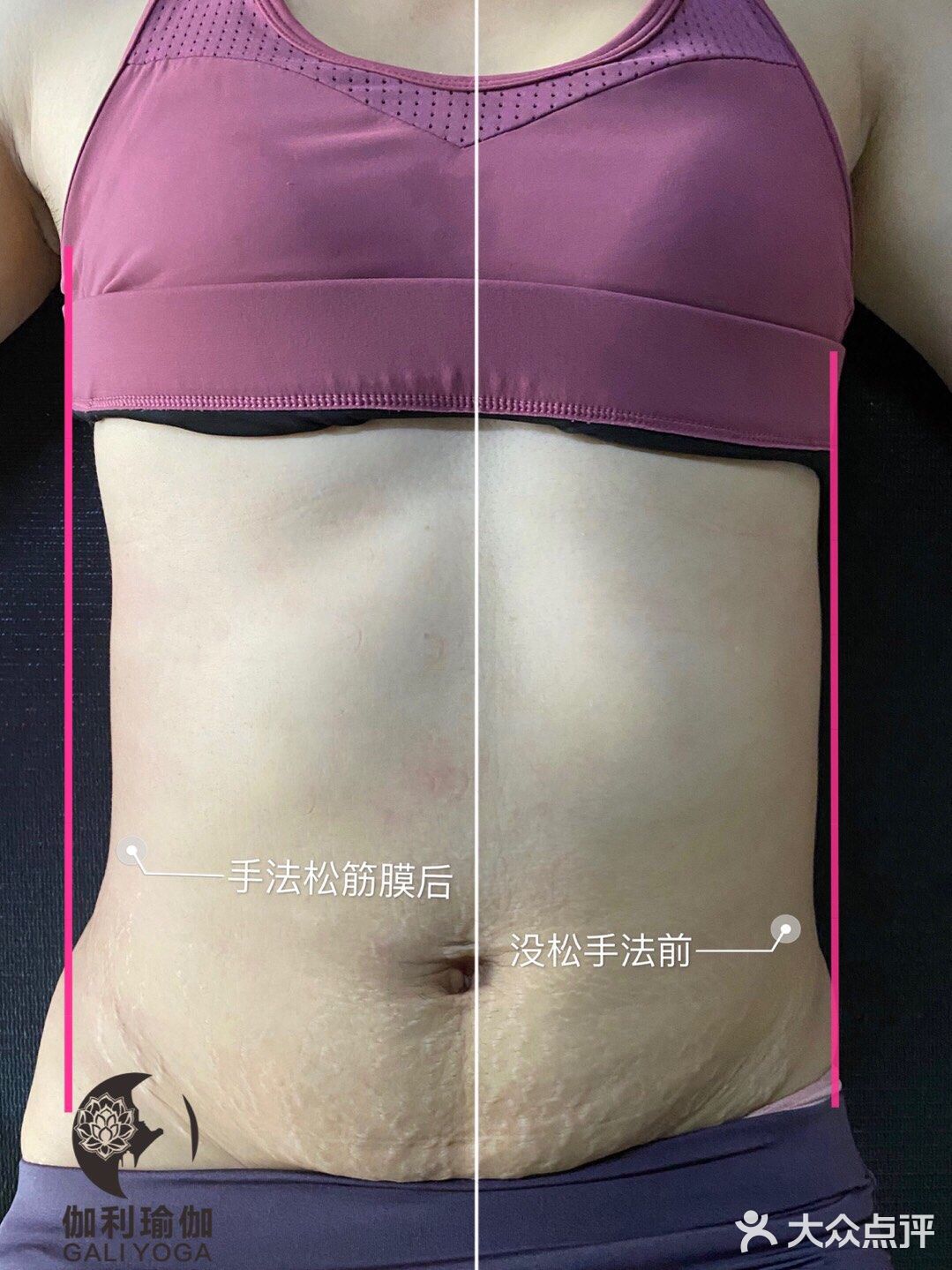 #产后修复