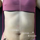 #产后修复