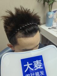-大麦微针植发全国连锁