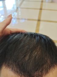 -碧莲盛·不剃发植发