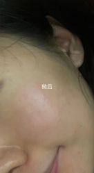 -爱莎扁平疣·汗管瘤·斑痣中心
