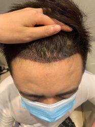 体验后-大麦微针植发全国连锁