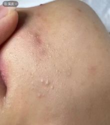 -苗方清颜专业祛痘·皮肤管理