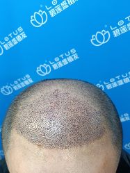 -碧莲盛·不剃发植发