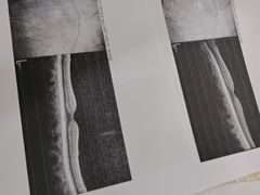 -成都新视界眼科医院·近视手术·儿童近视
