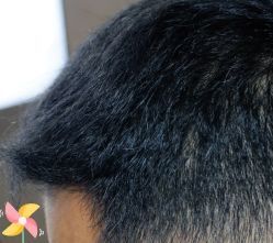 -大麦微针植发丨全国连锁