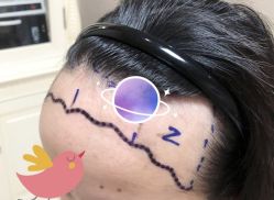 -大麦微针植发全国连锁