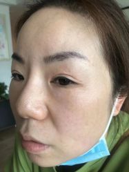 -爱莎扁平疣·汗管瘤·斑痣中心