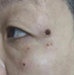 体验前-北京美痣堂古方祛痣斑疣瘊