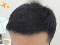 -大麦微针植发丨全国连锁