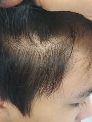 -大麦微针植发全国连锁