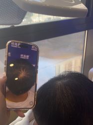 -碧莲盛·不剃发植发