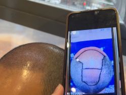 -碧莲盛·不剃发植发