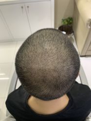 -大麦微针植发全国连锁