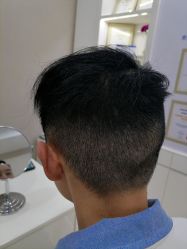 体验后-大麦微针植发丨全国连锁