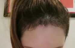 -大麦微针植发全国连锁