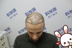 -大麦微针植发丨全国连锁