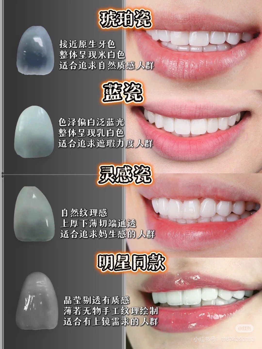 六月微笑瓷贴面