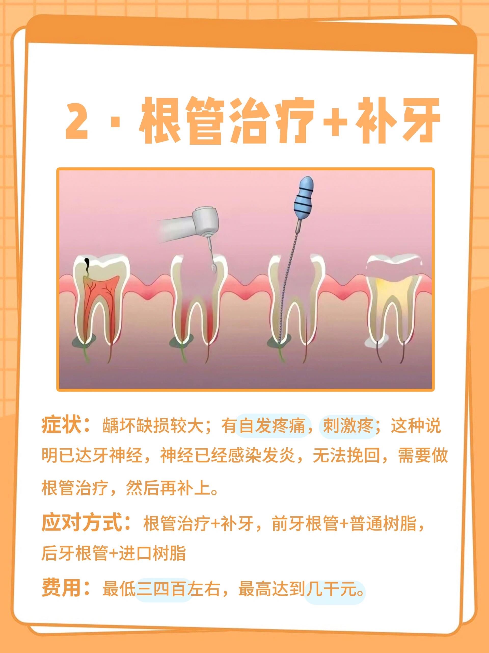 n7315补牙—如果孩子牙齿只有
