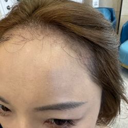 -碧莲盛·不剃发植发