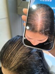 -碧莲盛·不剃发植发