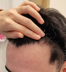 -大麦微针植发全国连锁