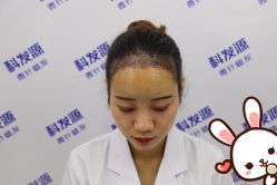 点击看大图 -大麦微针植发丨全国连锁