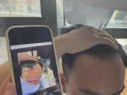 -碧莲盛·不剃发植发