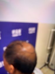 -碧莲盛·不剃发植发