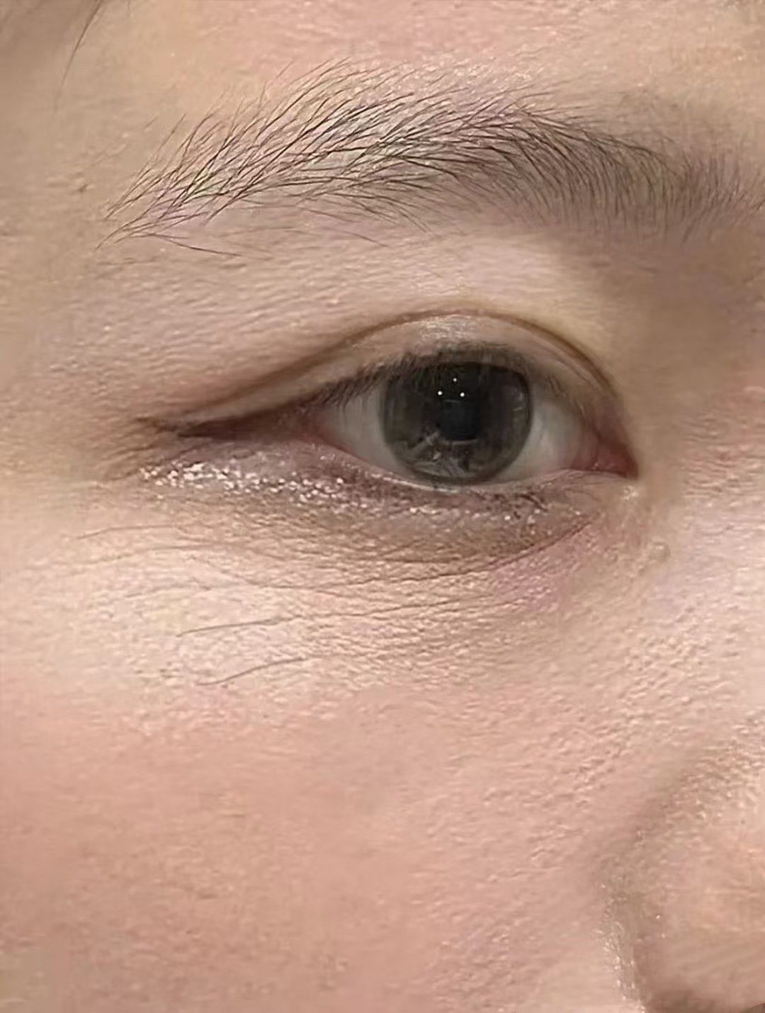 谁的眼周干纹竟复刻了蝴蝶翅膀?
眼周