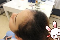 点击看大图 -大麦微针植发丨全国连锁