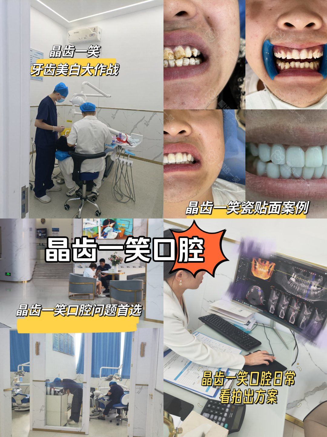 口腔如何修复重度氟斑牙