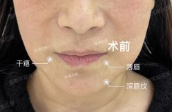 体验前-杭州米兰柏羽医疗美容医院