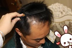 点击看大图 -大麦微针植发丨全国连锁