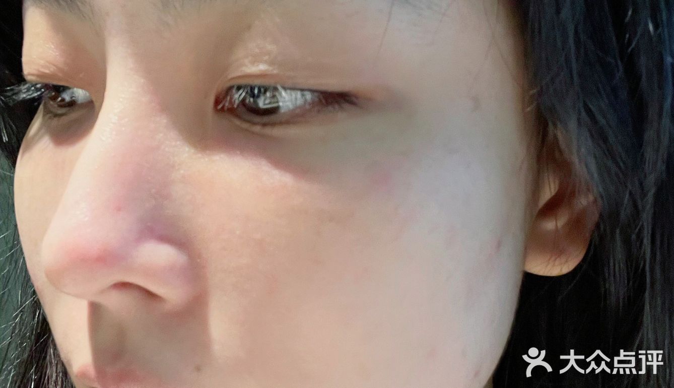 深圳｜做了一次黑眼圈的效果 一顿饭钱
