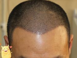 -大麦微针植发丨全国连锁