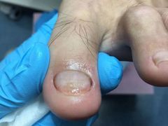 -Andrew指甲专科灰指甲·甲沟炎矫正·3D步态矫形鞋垫定制(浦三路店)