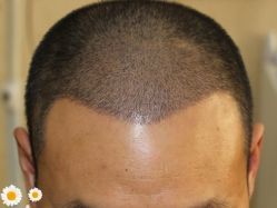 -大麦微针植发丨全国连锁