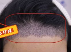 -大麦微针植发全国连锁